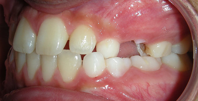 Child's left side view of teeth after treatment for an underbite with a plate